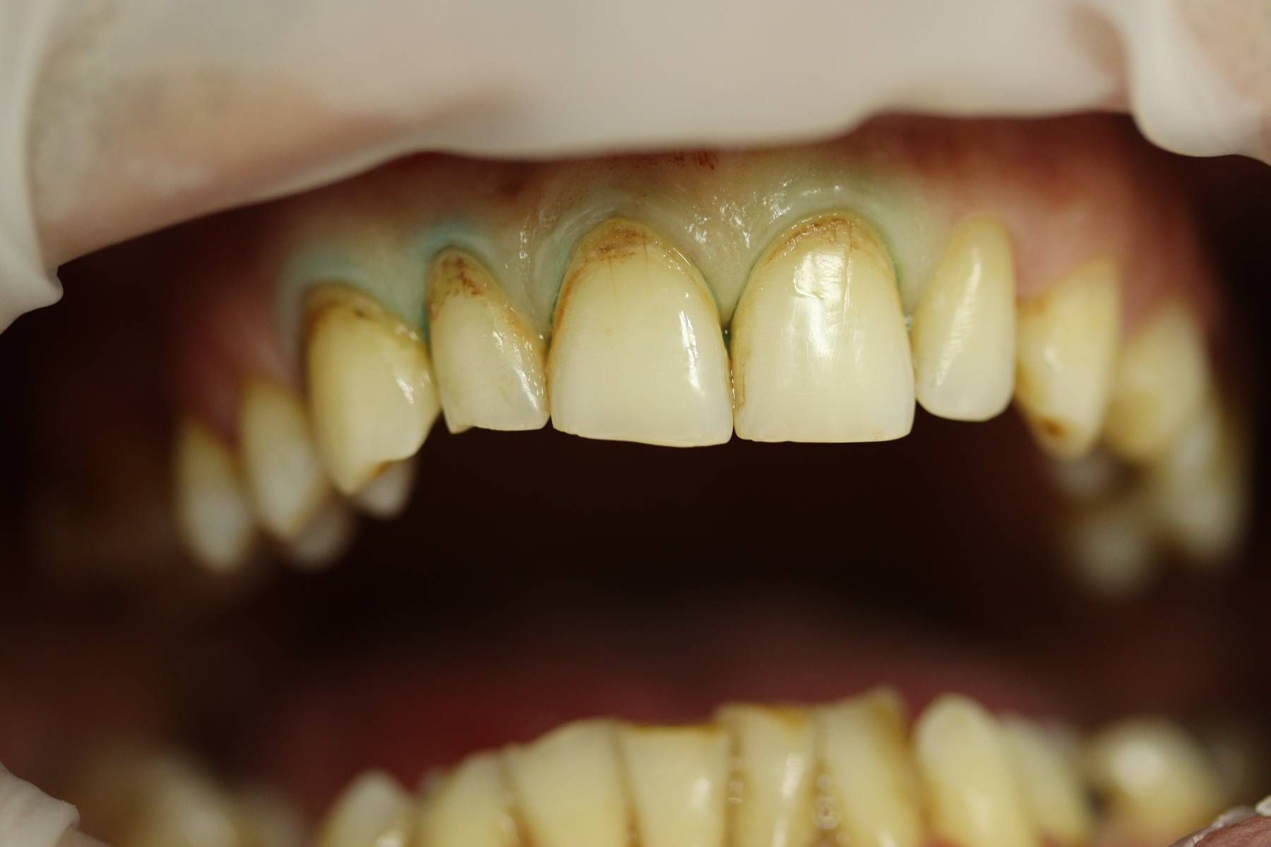 Реставрация четырёх зубов "до"