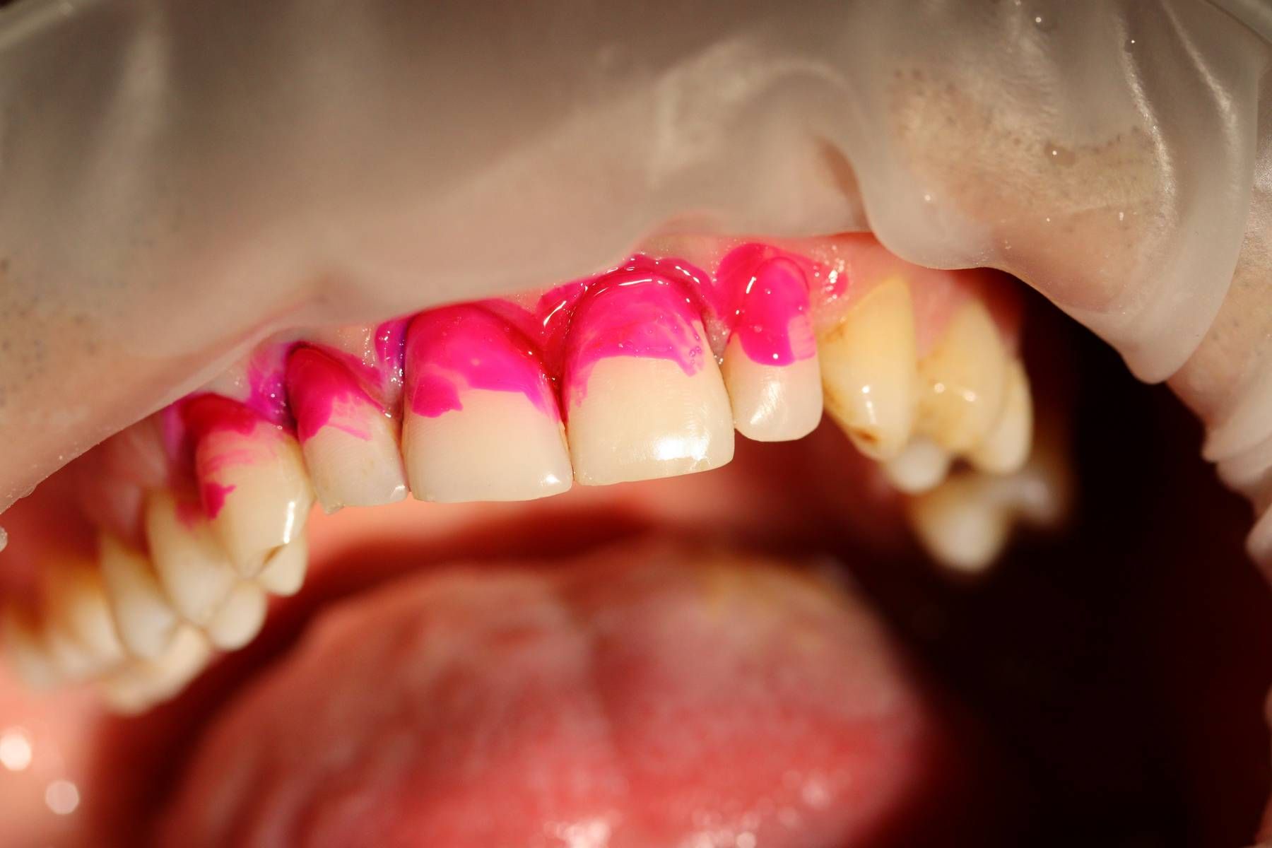 реставрациия 4-х зубов