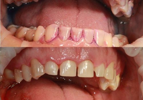 Профгигена аппаратом Prophylaxis master